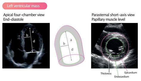 lv mass echocardiography|Left ventricular mass and volume (size) .